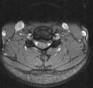 Figure 1. MRI image through C5-6 demonstrating left sided disc herniation.