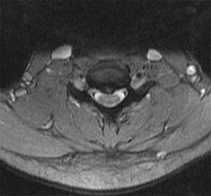 Figure 2. MRI image through C6-7 demonstrating central disc herniation.