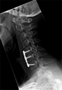 Figure 3. Lateral xray after 2 level ACDF.