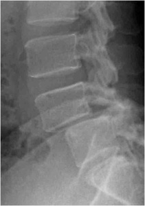 Figure 1. Pre-op lateral x-ray showing spondylolisthesis at L4-L5 (slipped vertebrae of L4 forward on L5) causing stenosis.