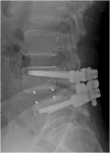 Figure 2. Post-op lateral x-ray showing PEEK spacer increased disc height, restored lordosis (normal curvature) and reduced slip of L4 on L5, thereby relieving stenosis. Additionally, pedicle screws provide stability to increase fusion success.