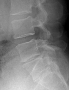 Figure 3. The pre-op lateral x-ray shows loss of disc height at L5-S1.