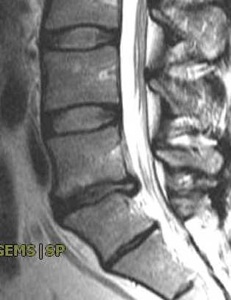 Figure 4. The pre-op MRI shows a dark disc at L5-S1 with loss of height and encroachment on the spinal canal causing stenosis.