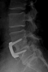 Figure 5. The post-op lateral x-ray shows the bone graft spacer in the disc space, which has restored the height of the disc and lordosis (normal curvature of the lumbar spine), and the anterior plate and screws.