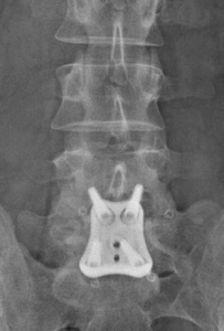 Figure 6. The post-op AP x-ray shows the plate and screws.