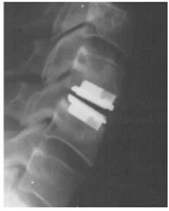 Figure 1. A lateral X-ray with the implant in place.