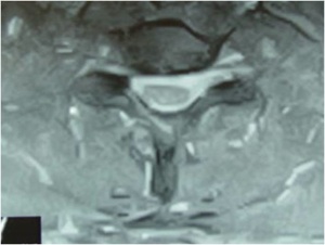 Figure 1. This is an MRI axial image that shows the narrowing of the foramen (black triangle) on the left of the picture causing compression of the exiting nerve root (white structure). This patient is an ideal example of a candidate for a minimally invasive microscopic foraminotomy.