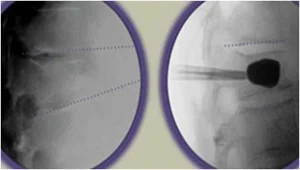 Figure 1. Lateral x-rays show the compression fracture on the left, with restoration of height of the vertebral body with injection of the cement on the right.