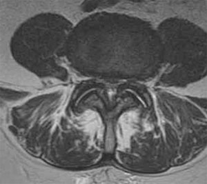 Figure 1. MRI image through L4-5 demonstrating severe central and lateral recess stenosis caused by disc bulges, thickened ligament, and enlarged bone spurs/joint capsules.