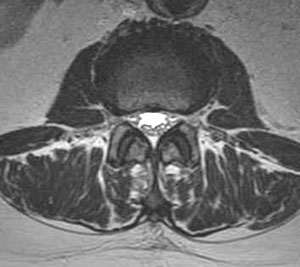 Figure 2. MRI image through L2-3 demonstrating a normal open spinal canal.