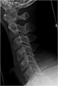 Figure 1. Pre-op lateral x-ray which demonstrates neutral curvature of the cervical spine with no instability.
