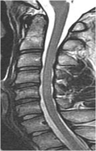 Figure 2. Pre-op MRI shows cervical stenosis with loss of spinal fluid (white) posterior (behind) the spinal cord (dark).