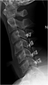 Figure 3. Post-op lateral x-ray shows expansion of spinal canal with trap-door laminoplasty procedure being held open with metal plates and screws.