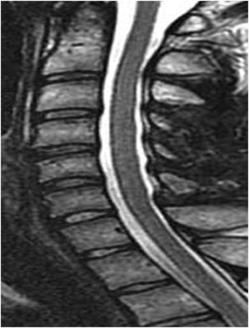 Figure 4. Post-op MRI shows restoration of spinal canal size and spinal fluid posterior to spinal cord.