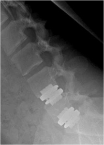 Figure 1. Post-op lateral flexion x-ray showing artificial discs at L4-5 and L5-S1.