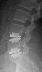 Figure 2. Post-op lateral extension x-ray showing motion of artificial disc opening up in front, especially at L4-5.