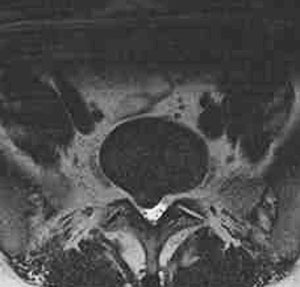 Figure 1. MRI image through L5-S1 demonstrating right paracentral disc herniation