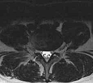 Figure 2. MRI image through L4-5 demonstrating a normal disc.