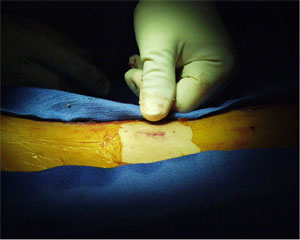 Figure 3. Surgical incision of 2 cm in length.