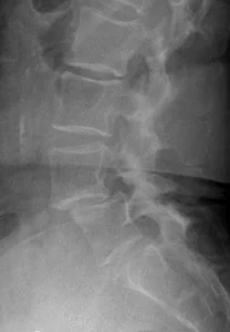 Figure 1. Pre-op lateral x-ray showing spondylolisthesis at L4-L5 (slipped vertebrae of L4 forward on L5) causing stenosis.