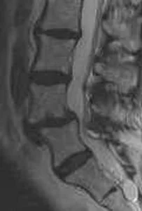 Figure 2. Pre-op MRI showing severe stenosis due to the slip of L4 forward on L5.
