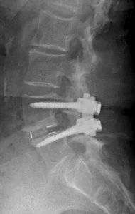 Figure 3. Post-op lateral x-ray showing PEEK spacer increased disc height, restored lordosis (normal curvature) and reduced slip of L4 on L5, thereby relieving stenosis. Additionally, pedicle screws provide stability to increase fusion success.
