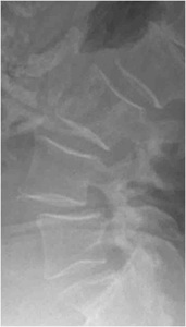 Figure 1. Pre-op lateral x-ray showing spondylolisthesis at L4-L5 causing stenosis.