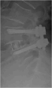 Figure 2. Post-op lateral x-ray showing PEEK spacer increased disc height, restored lordosis, and reduced vertebral slippage, with pedicle screws providing stability.